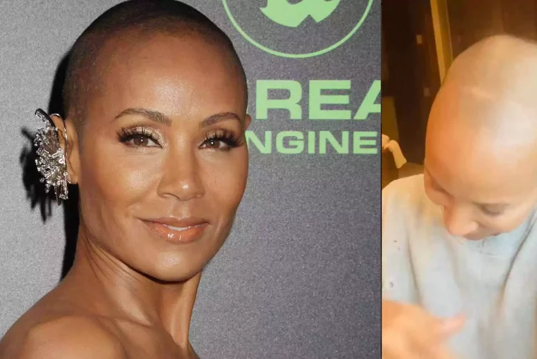 Jada Pinkett Smith Reveals About His Alopecia Hair Loss, Says the Report
